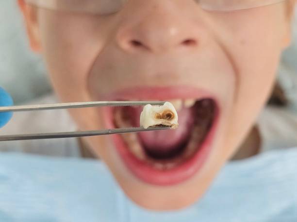 Best Urgent Care for Lost Fillings or Crowns in Country Walk, FL